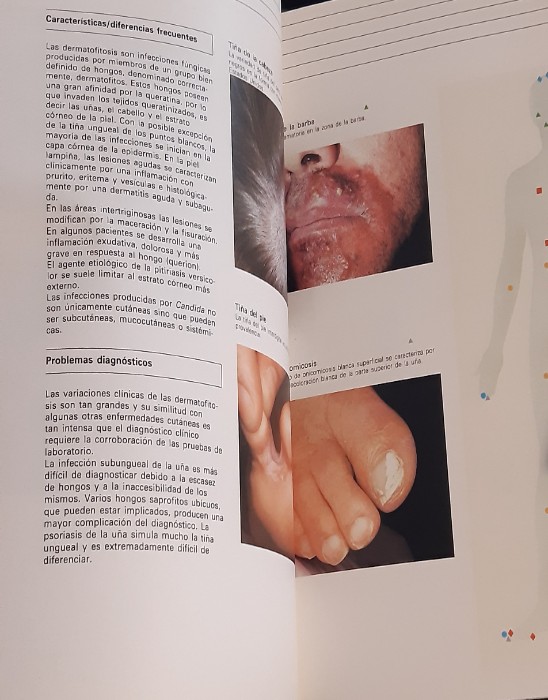 Imagen 2 del libro Infecciones cutáneas - fúngicas y bacterianas
